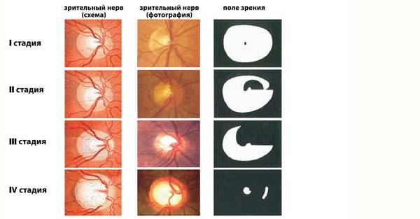 Стадии атрофии зрительного нерва