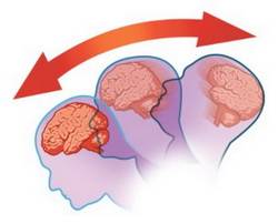 Механизм сотрясения мозга, 3 этапа
